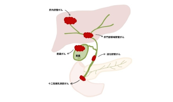 胆道がんの発生部位による分類