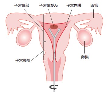 図（子宮体がん）