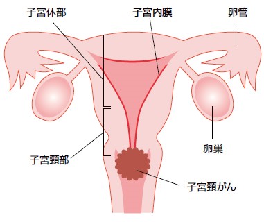 図（子宮頸がん）