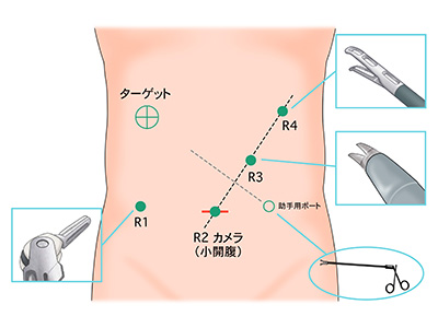 大阪国際がんセンター　大腸外科 大腸癌、直腸癌、結腸癌、手術、ロボット手術、腹腔鏡手術、低侵襲手術、手術手順、手術方法、術式、吻合方法、右半結腸切除術、R1〜R4にロボット用ポートを挿入します。ロボットとドッキング後にポートからカメラやインストゥルメント（鉗子）を挿入します。助手が腹腔鏡用の鉗子で手術をサポートします。ハサミ、把持鉗子、持針器