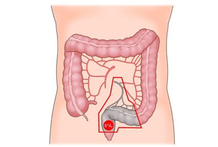 大阪国際がんセンター　大腸外科 大腸癌、直腸癌、結腸癌、手術、ロボット手術、腹腔鏡手術、低侵襲手術、手術手順、手術方法、術式、吻合方法、下部直腸後壁部分に腫瘍を同定。赤線の範囲の腫瘍を含む腸管とリンパ節の切除を行います。