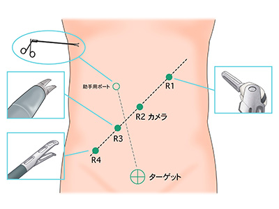 大阪国際がんセンター　大腸外科 大腸癌、直腸癌、結腸癌、手術、ロボット手術、腹腔鏡手術、低侵襲手術、手術手順、手術方法、術式、吻合方法、R1〜R4にロボット用ポートを入れます。ロボットとドッキング後にポートからカメラやインストゥルメント（鉗子、ハサミ型の電気メス、自動縫合器など）入れます。助手は腹腔鏡用の鉗子でサポートします。