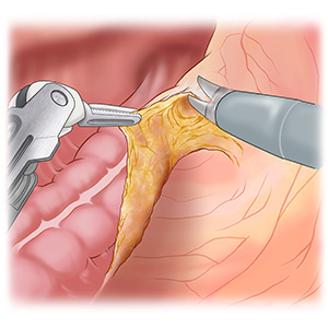 大阪国際がんセンター　大腸外科 大腸癌、直腸癌、結腸癌、手術、ロボット手術、腹腔鏡手術、低侵襲手術、手術手順、手術方法、術式、吻合方法、ハサミ型の電気メスで後腹膜からS状結腸と直腸を剥離し切除する部分を、慎重に授動します。