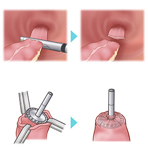 大阪国際がんセンター　大腸外科 大腸癌、直腸癌、結腸癌、手術、ロボット手術、腹腔鏡手術、低侵襲手術、手術手順、手術方法、術式、吻合方法、病巣から2〜３cm離して直腸を自動縫合器で切離します。残ったS状結腸側の断端を体腔外に導出し、自動吻合器の先端（アンビル）を装着します。切除された腫瘍が含まれる腸管は、小切開創（お臍）から取り出します。