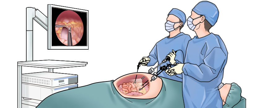 ロボット支援低手術と腹腔鏡手術について