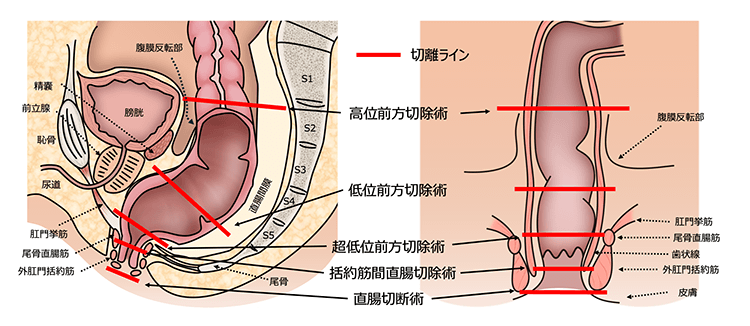 直腸がんに対する手術