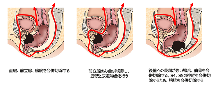 骨盤内蔵全摘術