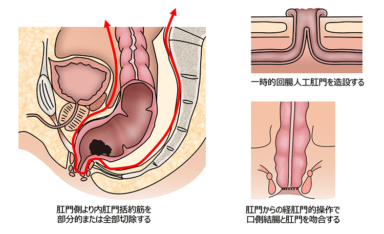 括約筋間切除術