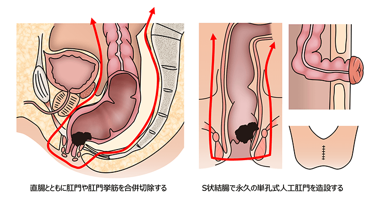 腹会陰式直腸切断術