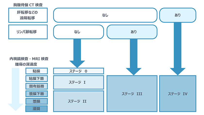 大腸がんのステージ診断