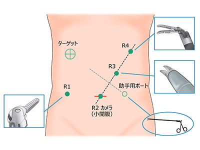 大阪国際がんセンター　大腸外科 大腸癌、直腸癌、結腸癌、手術、ロボット手術、腹腔鏡手術、低侵襲手術、手術手順、手術方法、術式、吻合方法、右半結腸切除術、R1〜R4にロボット用ポートを挿入します。ロボットとドッキング後にポートからカメラやインストゥルメント（鉗子）を挿入します。助手が腹腔鏡用の鉗子で手術をサポートします。ハサミ、把持鉗子、持針器