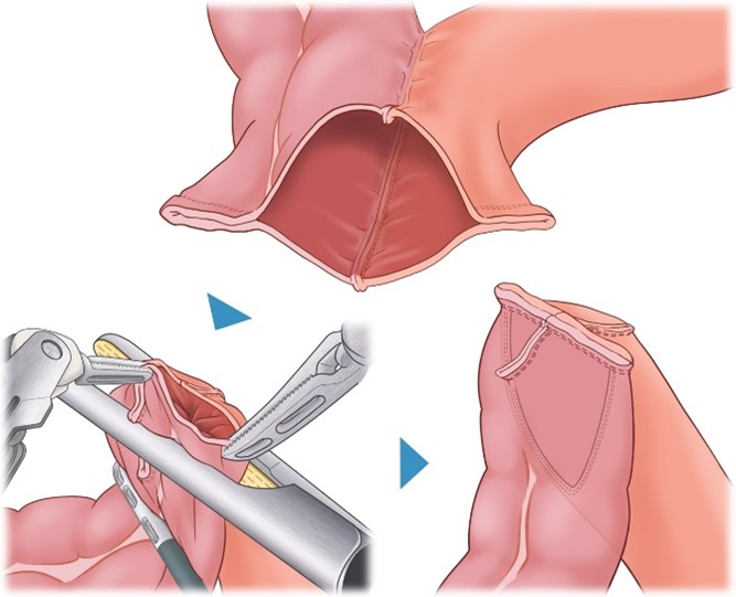 大阪国際がんセンター　大腸外科 大腸癌、直腸癌、結腸癌、手術、ロボット手術、腹腔鏡手術、低侵襲手術、手術手順、手術方法、術式、吻合方法、右半結腸切除術、上行結腸部にがんを同定。吻合口が作られ、上行結腸と回腸が開通した状態になります。最後に開いている口を自動縫合器で閉鎖します。