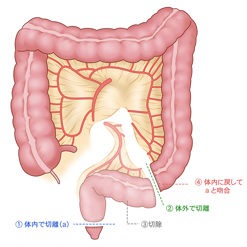 大阪国際がんセンター　大腸外科 大腸癌、直腸癌、結腸癌、手術、ロボット手術、腹腔鏡手術、低侵襲手術、手術手順、手術方法、術式、吻合方法、剥離が終了すると、がんの進行度に合わせて腸管膜を切除範囲を決定します