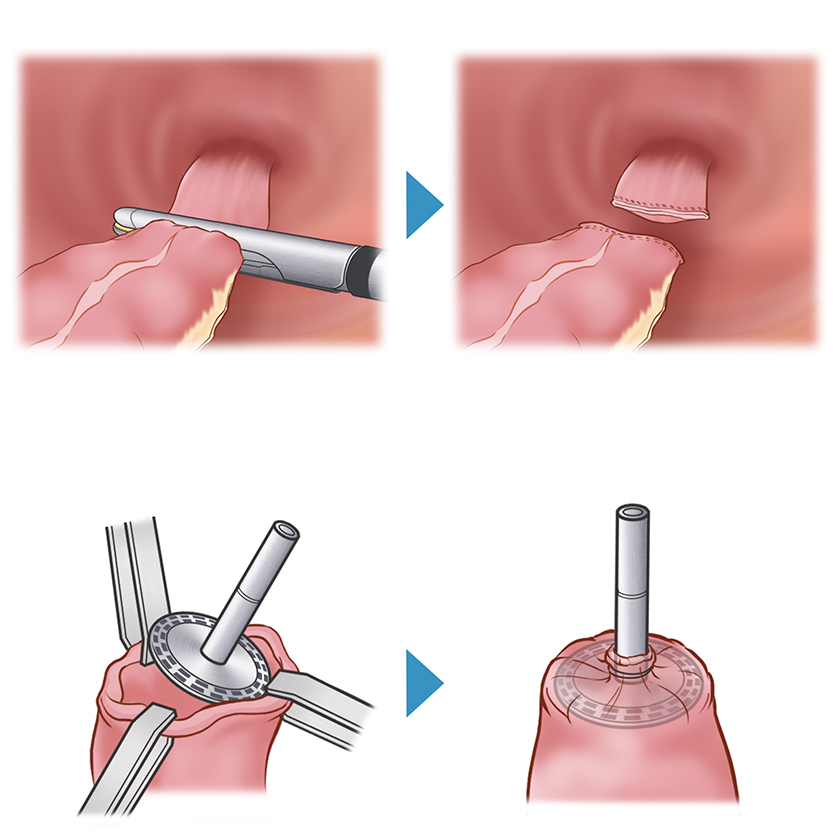 大阪国際がんセンター　大腸外科 大腸癌、直腸癌、結腸癌、手術、ロボット手術、腹腔鏡手術、低侵襲手術、手術手順、手術方法、術式、吻合方法、病巣から2〜3cm離して直腸を自動縫合器で切離します。残ったS状結腸側の断端を体腔外に導出し、自動吻合器の先端（アンビル）を装着します。切除された腫瘍を含む腸管は小切開創（臍）から取り出します。