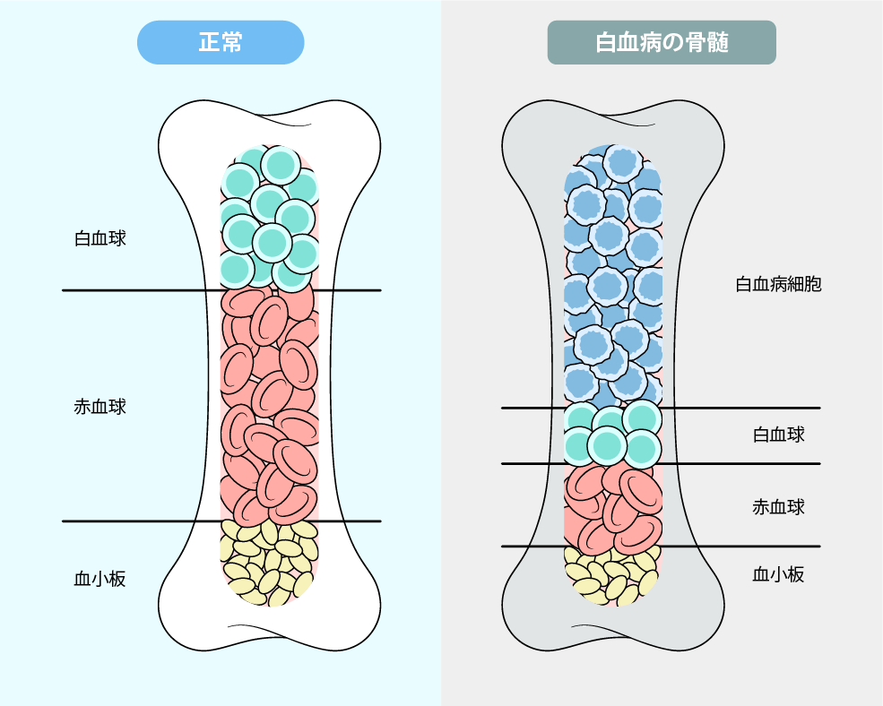 白血病（急性・慢性）