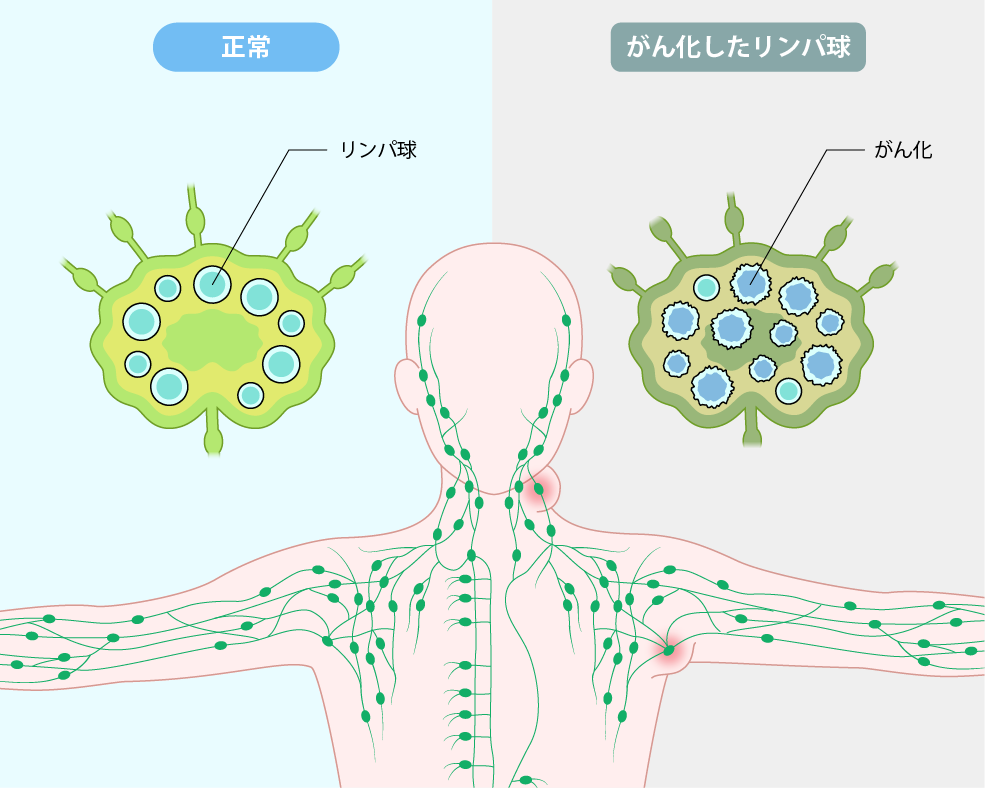 悪性リンパ腫