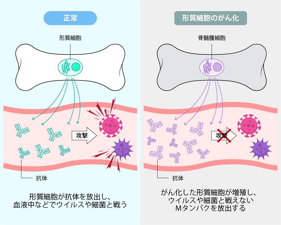 多発性骨髄腫