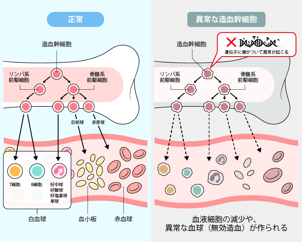 骨髄異形成症候群