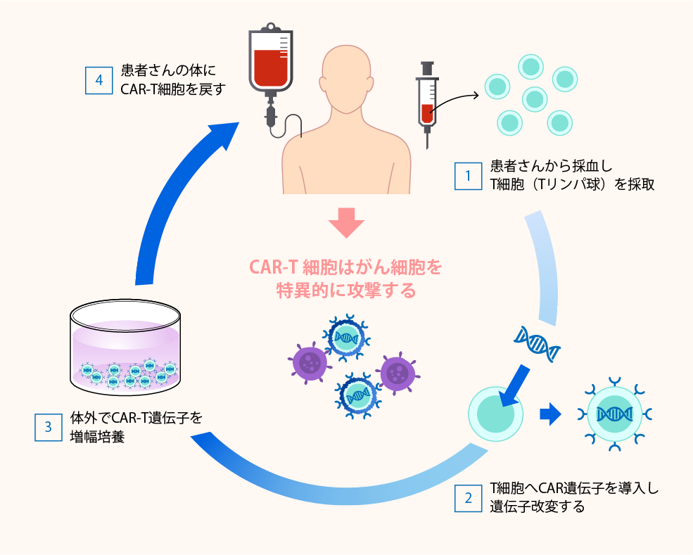 キメラ抗原受容体T細胞療法（CAR-T療法）