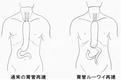 大阪国際がんセンター